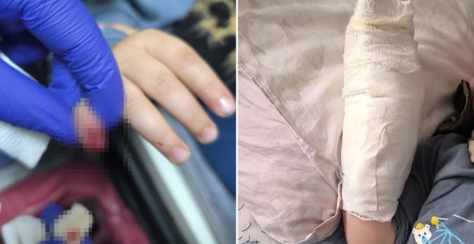 AVM’de yürüyen merdivene eli sıkışan çocuğun parmağı koptu