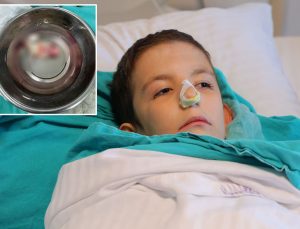 Burun tıkanıklığı şikayetiyle hastaneye gitti, ağzından dev bir polip çıkartıldı