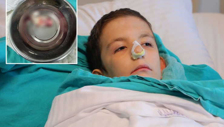 Burun tıkanıklığı şikayetiyle hastaneye gitti, ağzından dev bir polip çıkartıldı