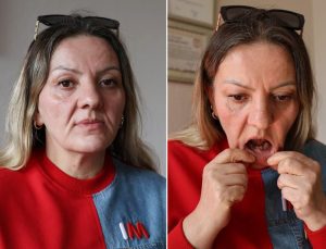 Diş ağrısı şikayetiyle gitti, 25 dişinden oldu