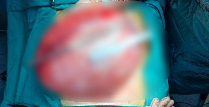 Kilo vermek için hastaneye giden çocuğun karnından 3,5 kiloluk kist çıktı