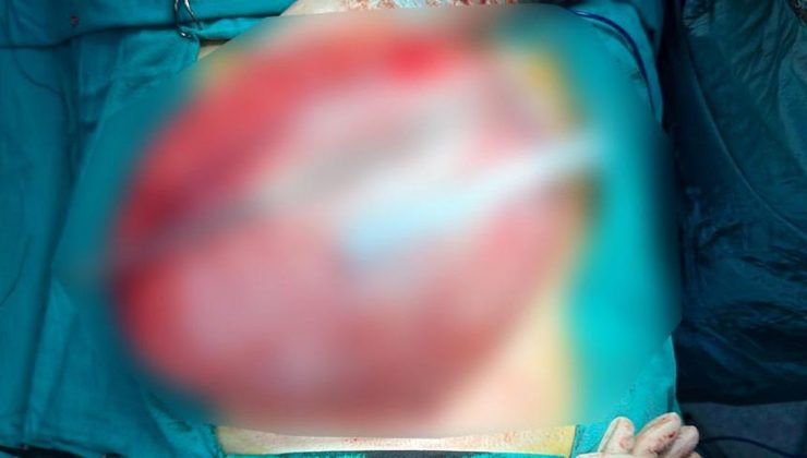 Kilo vermek için hastaneye giden çocuğun karnından 3,5 kiloluk kist çıktı