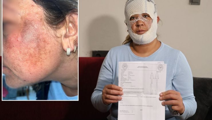 Prenses cilt bakımı yüzünü yaktı: Oğlum "öcü" deyip benden kaçıyor